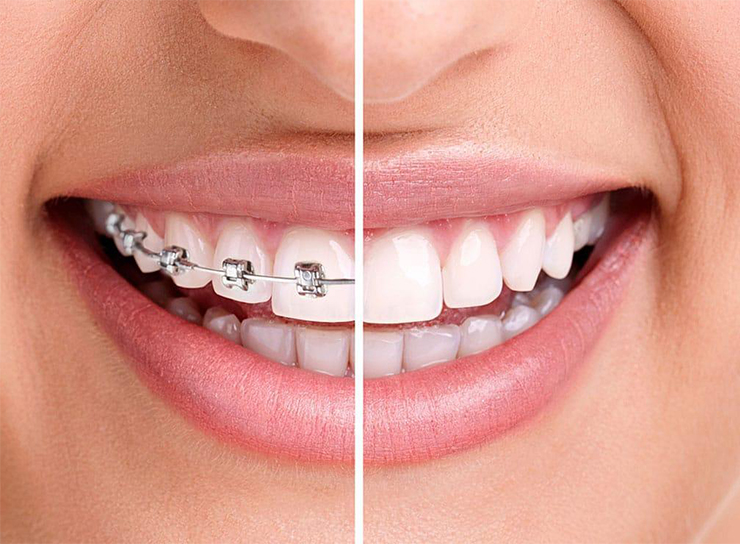 Orthodontic Treatment