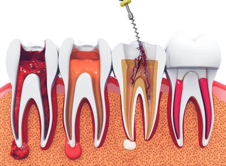 Root Canal Treatment