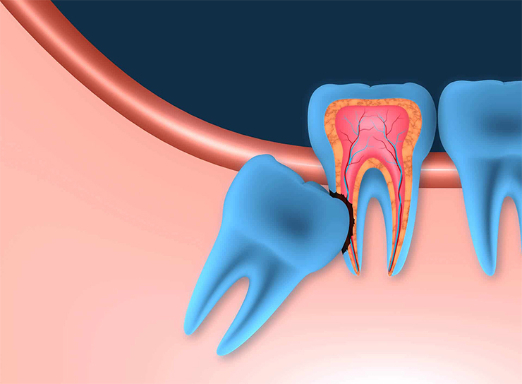 Wisdom Teeth Surgery